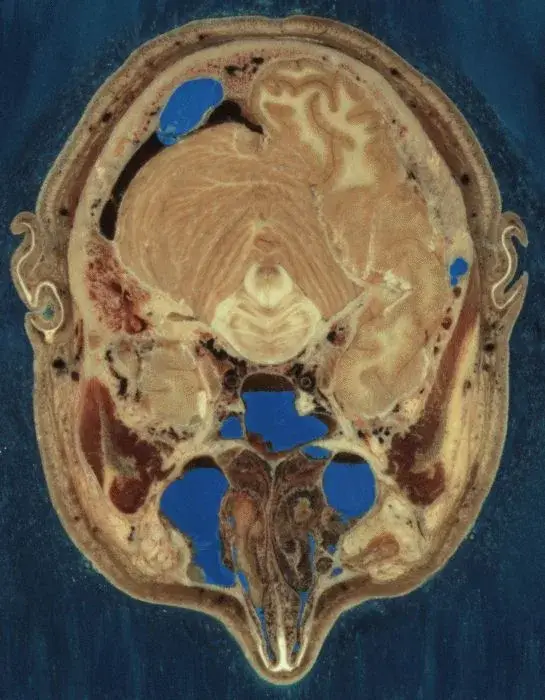 Coupe couleur de la tête du Visible Human Male montrant cerveau, voies nasales et tissus environnants